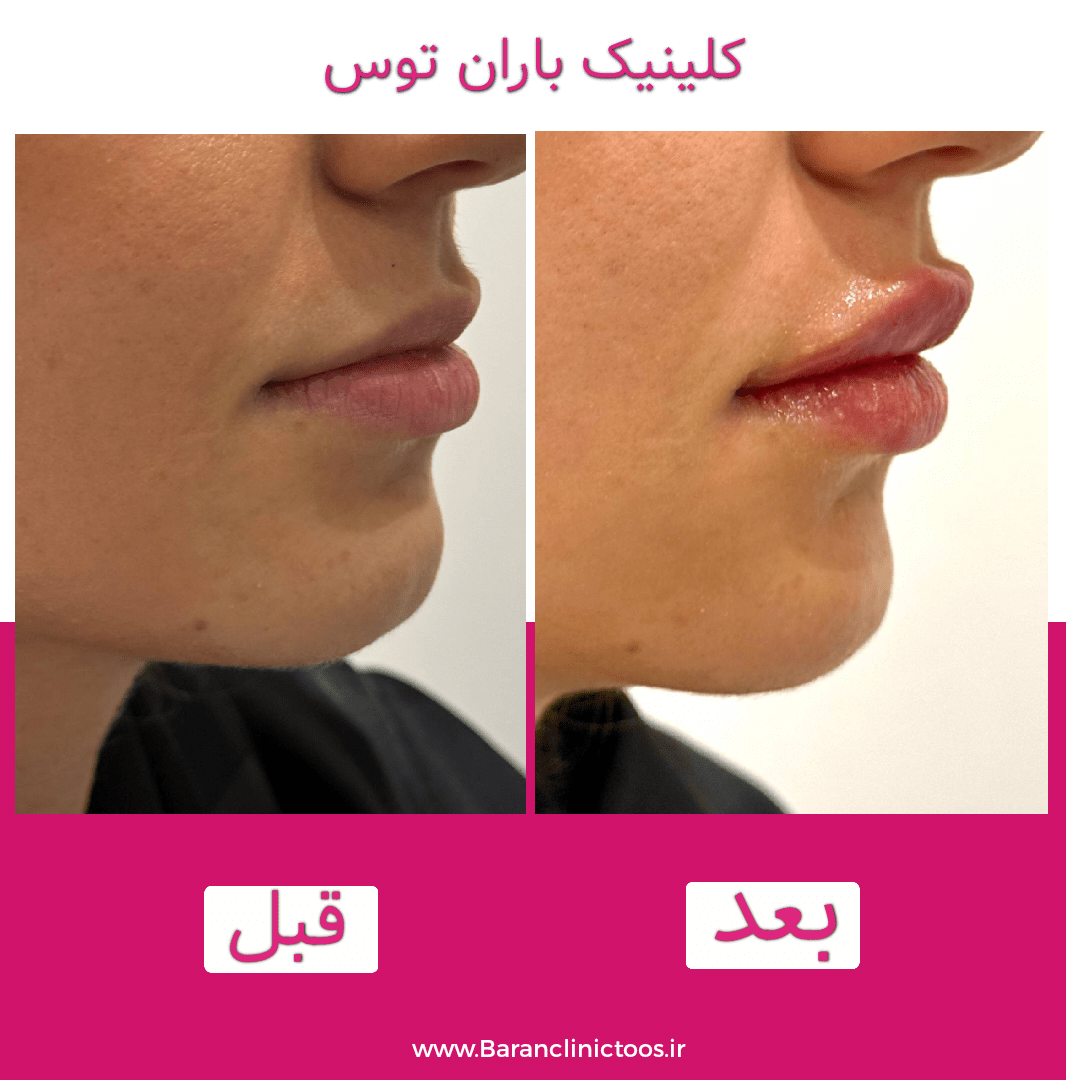 قبل و بعد فیلر لب